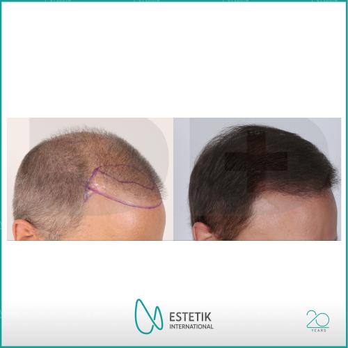 Organic hair transplantation Before / After photo
